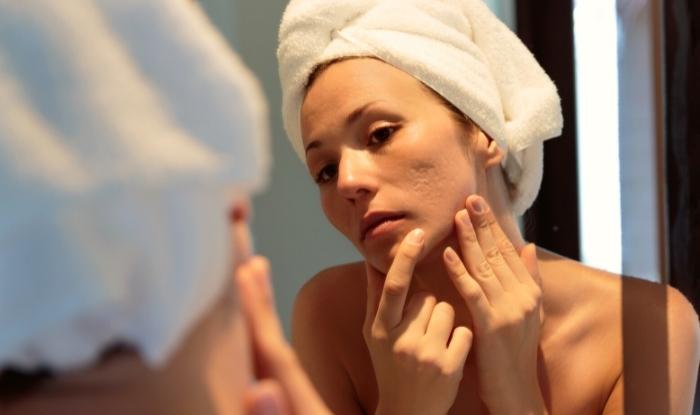 ¿Qué es el acné? Síntomas, Tipos y Tratamientos