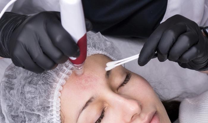 Procedimiento con microagujas: la tecnología que rejuvenece tu piel