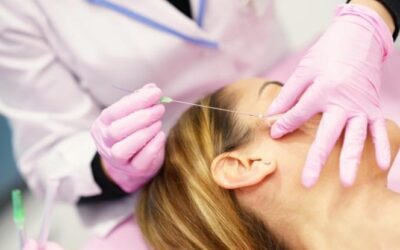 Hilos tensores procedimiento estético sin cirugía: la alternativa al lifting facial.