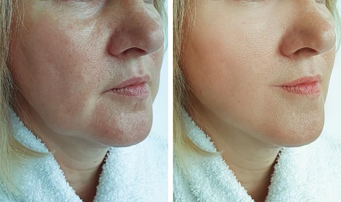 Cuidados del Lifting Facial antes y después de realizarlo