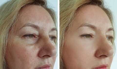 Hilos Tensores para un Rostro Joven y Radiante: Resultados Antes y Después