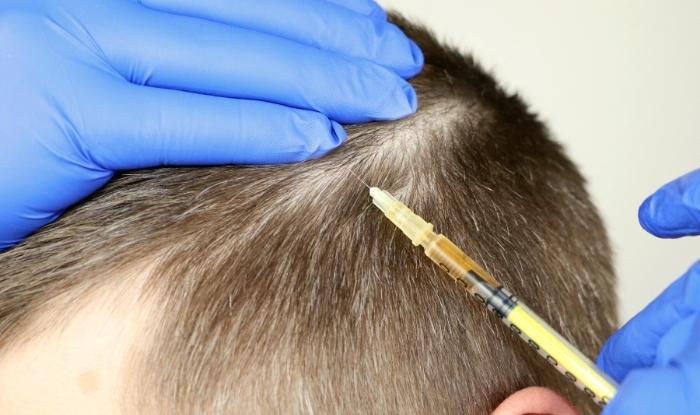 Tratamiento para la alopecia areata