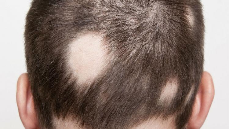 cabea de hombre con muestras de alopecia areata.