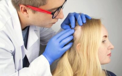 Alopecia areata: ¿Qué es? Causas, síntomas, diagnóstico y tratamiento