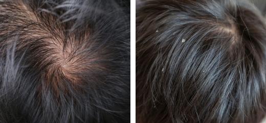 Cabeza de paciente mostrando el antes y después del tratamiento capilar con PRP