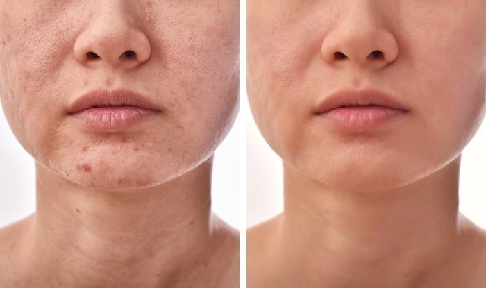 Antes y después del tratamiento para el acné.