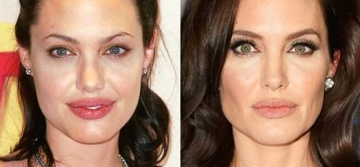 Antes y después Angelina Jolie tratamiento de Bichectomía