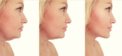 Rostro de mujer mostrando el antes y después de la Corrección del Mentón sin Cirugía.