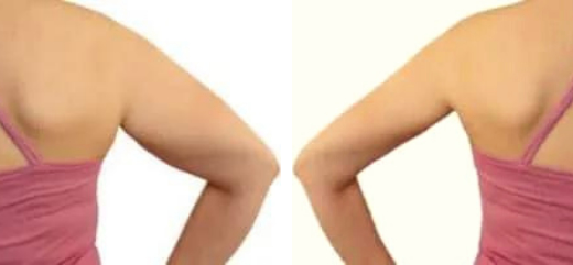 Antes y después del tratamiento de liposucción de brazo sin cirugía.