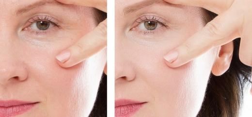 Mujer con dedos en la cara mostrando un antes y después del tratamiento con rellenos dérmicos