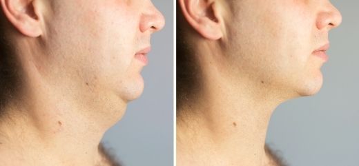 Mujer mostrando antes y después del tratamiento de papada sin cirugía.
