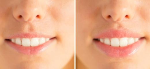 Antes y después del tratamiento de aumento de labios