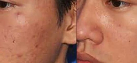 Antes y después de rostro con acne