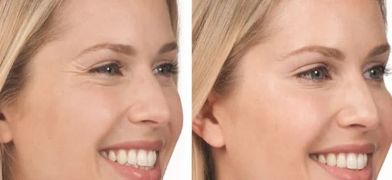 Antes y después del tratamiento con Bótox en rostro de mujer.