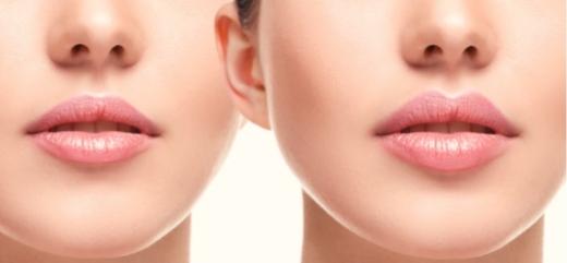 Antes y después tratamiento aumento de labios