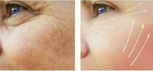 Mujer mostrando antes y después del tratamiento de microneedling