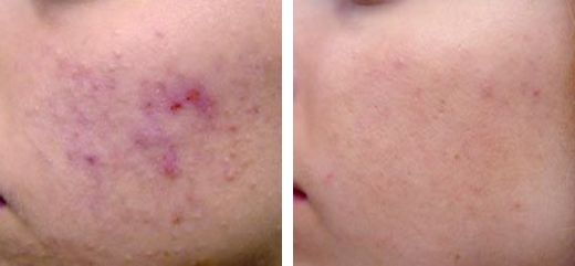 Tratamiento Activo Acne Courtesy of: Robin Sult, R.N. Laser source: Nd:YAG (1064 nm)