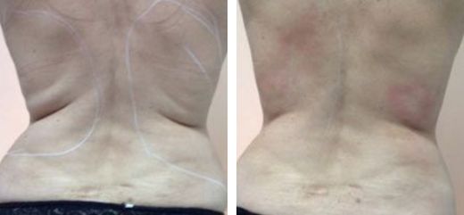 Antes y después TightSculpting - remodelamiento Corporal con láser