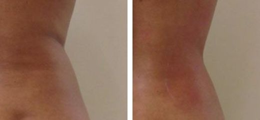 Antes y después TightSculpting - remodelamiento Corporal con láser