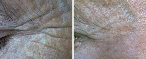 Antes y después del tratamiento de Resurfacing Cutáneo  Periocular con Láser Fotona
