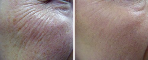 Antes y después del tratamiento de Resurfacing Cutáneo para arrugas con Láser Fotona