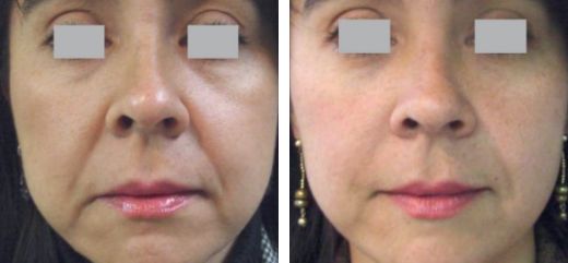 Antes y después de tratamiento láser Fotona para rejuvenecimiento facial
