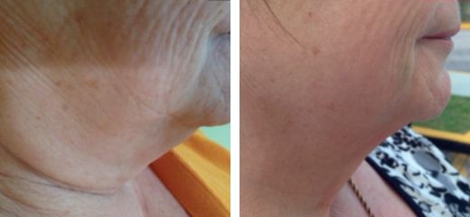 Antes y después de tratamiento de rejuvenecimiento facial con Láser Fotona