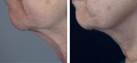 Antes y después de tratamiento de rejuvenecimiento facial con Láser Fotona